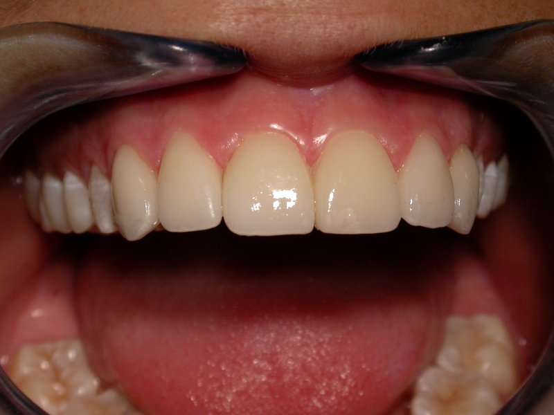 Treatment - Image at Frenchs Forest Dental