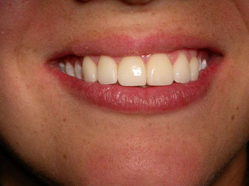 Smile - Image at Frenchs Forest Dental