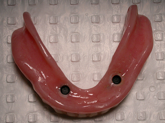 Implant Denture - Frenchs Forest Dental