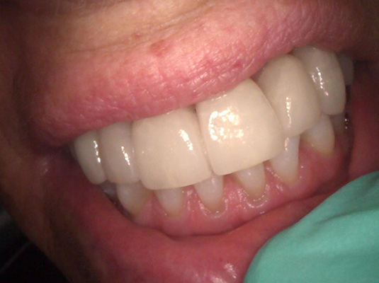 Frenchs Forest Dental - Teeth Whitening