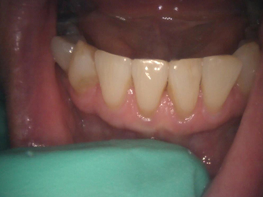 Teeth Whitening - Frenchs Forest Dental