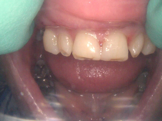 Teeth Whitening C - Frenchs Forest Dental