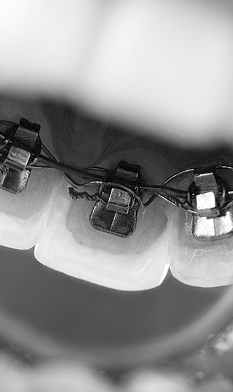 Brace - Image at Frenchs Forest Dental