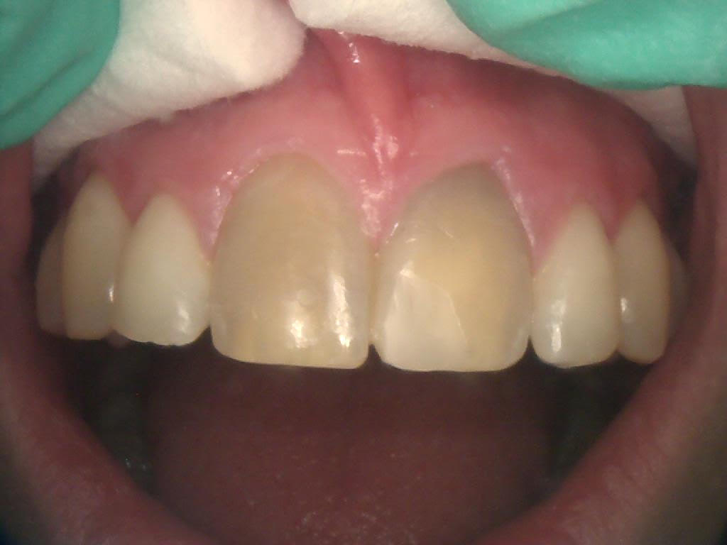 Teeth Whitening treatment - Frenchs Forest Dental