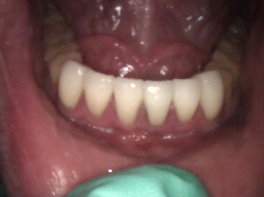 Tooth Colored Filling 4- Frenchs Forest Dental