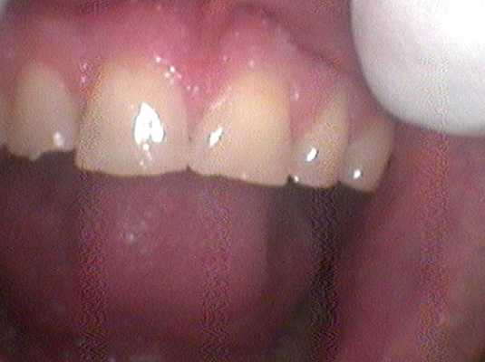 Tooth Colored Filling- Frenchs Forest Dental