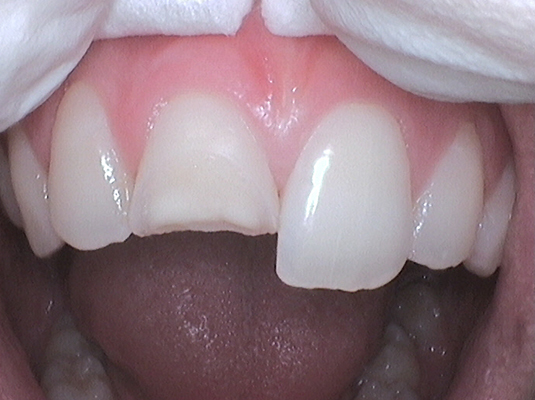 Resin Repair B- Frenchs Forest Dental