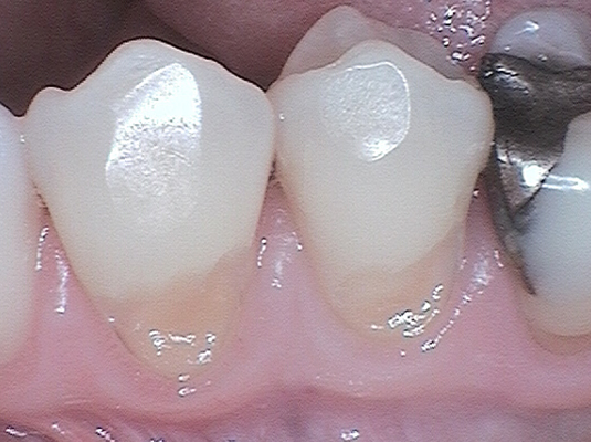 Resin B - Frenchs Forest Dental